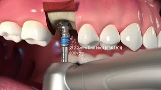 Protocole de pose de l’implant Straumann® TLX [upl. by Ciccia968]