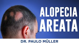 Alopecia Areata Falhas no Cabelo  Dr Paulo Müller Dermatologista [upl. by Nader]