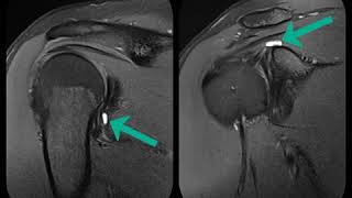 Shoulder MRI SLAP Type 3 Labral Tear 360 Degree Labral Tear [upl. by Ydnil]