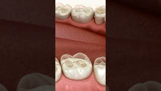 Dental Erosion Prevalence Incidence and Distribution  Pocket  dentist dentistteeth [upl. by Inatsed]