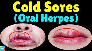 Cold Sores Oral HerpesHSV1  Fever Blisters – Symptoms Causes Treatment amp Prevention [upl. by Oirromed]