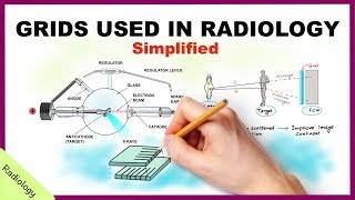 Grids Used in Radiology Simplified  Radiology [upl. by Heman]