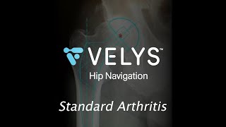 VELYS Hip Navigation for a Standard Hip Arthritis [upl. by Nalid]