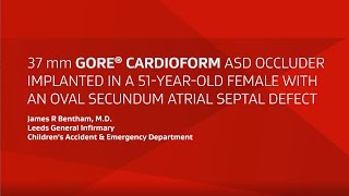 GORE® CARDIOFORM ASD Occluder implant in an oval secundum ASD [upl. by Ewald608]