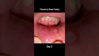 Aphthous Ulcer Time Lapse From Development to Healing Cold Sore [upl. by Yliab]