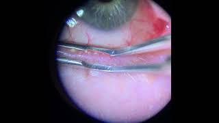 Meibomian Gland Expression Upper and Lower Lid [upl. by Balliett]