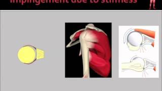 Rotator Cuff Impingement amp Tears [upl. by Curcio]