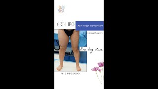 Feeling Light and Confident with 360° Thigh Liposuction at ArtLipo [upl. by Sammons]