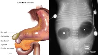 Annular Pancreas  whats that  😀😀 Double bubble sign  🤔🙄🤩 SSTOMACH  DDUODENUM [upl. by Attiuqehs]