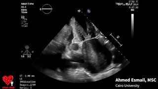 Rheumatic Valvular Heart disease with LA thrombus  Ahmed Esmail [upl. by Lorain637]