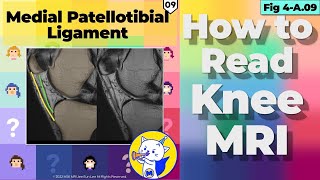 Fig 4A09 Medial Patellotibial Ligament MPTL Sagittal image [upl. by Tingey]