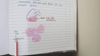 Lobar Pneumonia And Bronchopneumonia  Pathology [upl. by Halueb]