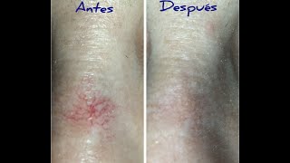 Vascular Spider Removal The BonoBlend Technique Before amp After Pictures [upl. by Mitzl]