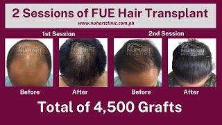 2 Sessions of FUE Hair Transplant  Total of 4500 Grafts [upl. by Uohk]