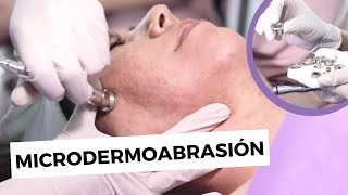 MICRODERMOABRASIÓN FACIAL Protocolo tips y resultados [upl. by Eilagam]