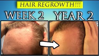 Coconut Oil  Castor Oil Hair Regrowth  YEAR 2 [upl. by Reinaldos776]