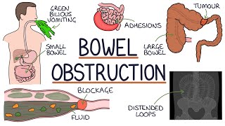 Understanding Bowel Obstruction [upl. by Aylat25]