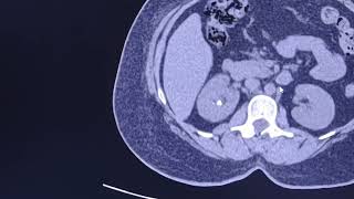 Renal ureteric stone hydronephrosis and renal swelling CT findings [upl. by Okomot]