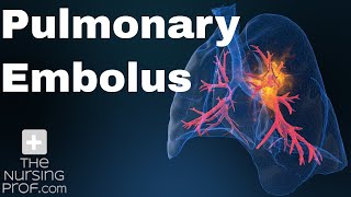 Pulmonary Embolus Nursing Care [upl. by Thamora]