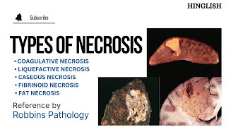 Necrosis  Types of Necrosis  Coagulative  Liquefactive  caseous  Fat  Fibrinoid  KTC MBBS [upl. by Maril]