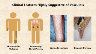 Vasculitis  An Overview [upl. by Ahsekyt]