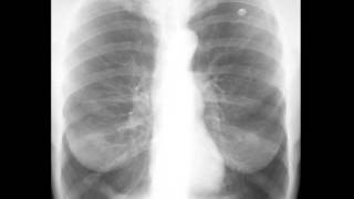 Emphysema on Chest X ray [upl. by Ettevroc]