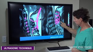 Cervical Stenosis Traditional Technology vs Newer Ultrasonic Technology for Spine Surgery [upl. by Krishna419]