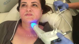 BTL Exilis Ultra  Neck Lift Skin Tightening  Cellulite Reduction  Beverly Hills [upl. by Mora]