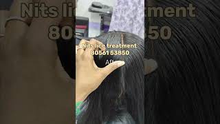 wait for end 😱 Nits lice removal treatment 100 result headlicetreatmentliceremovalhairlicelice [upl. by Lekcar256]