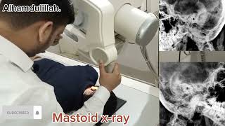 mastoid xray position in Urdu Hindidoctor physiotherapy mbbs [upl. by Ettevets999]