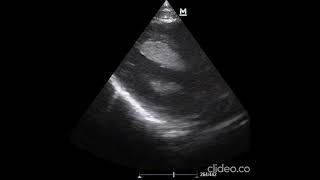 Isolated asymptomatic fetal intracardiac mass  Supplementary video ID 402663 [upl. by Seif]