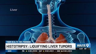 YOUR HEALTH Histotripsy Liquifying liver tumors [upl. by Ursal]