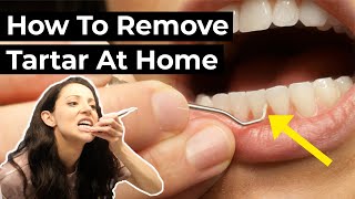 Is it Possible To Remove Tartar At Home [upl. by Raimondo]