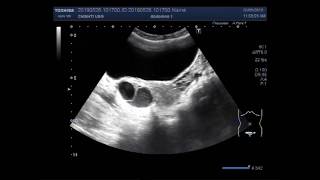 Ultrasound Video showing difference between the simple and hemorrhagic ovarian cysts [upl. by Thacker]