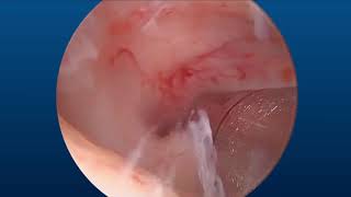 Myomectomy featuring the TruClear™ hysteroscopic tissue removal system [upl. by Ayitahs242]