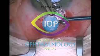 Trabeculectomy Step by Step Part 3 Preview [upl. by Irrab]