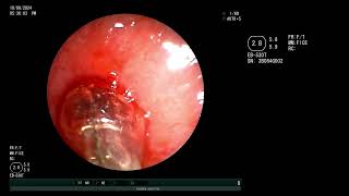 Emergent Central airway obstruction Subglottic stenosis  Dilatation and silicone stent placement [upl. by Babcock]