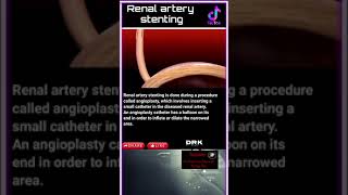 Renal artery stenting [upl. by Zsa]