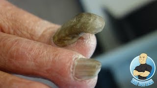 RAMS HORN 4 YEARS WITHOUT BEING CUT EXTREME TOENAIL CUTTING OF A THICK NAIL [upl. by Conn]