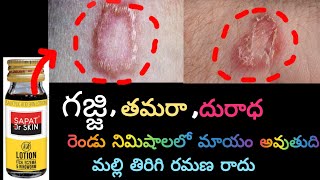 Allergies and fungal infections control with sapat lotion in telugu ll Ringworm 😷  Ring Warm cure [upl. by Ayotel]