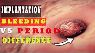 Implantation Bleeding Vs Period – How to Know the Difference 🩸🩸 [upl. by Garrik]