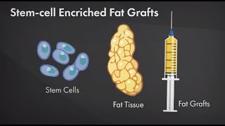 Is Fat Grafting Safe After Breast Cancer Plastic Surgery Hot Topics with Rod J Rohrich MD [upl. by Davide]