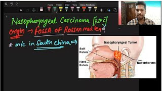 Nasopharyngeal carcinoma  Nasopharyngeal cancer  NPC  TROTTERS TRIAD  fmge neetpg [upl. by Melosa]