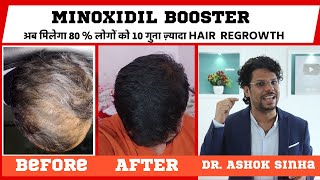 Minoxiboost Minoxidil Booster For Hair Growth  New Hair Research  10x More Result  Hair Loss [upl. by Annol90]