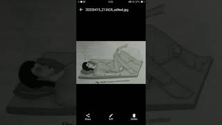 Lithotomy position [upl. by Yecac600]