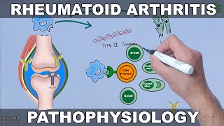 Rhematoid Arrhritis  Pathophysiology Mechanism [upl. by Fabian]