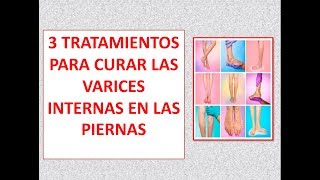 3 tratamientos para como curar las varices internas en las piernas [upl. by Nitsug922]