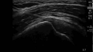 Video 5 SASDB Injection USPM Shoulder [upl. by Fendig]