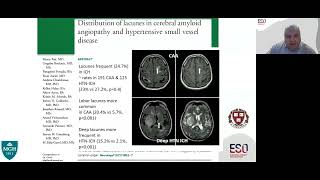 Lacunar Ischaemic Stroke  Clinical Perspectives [upl. by Aicirtel360]