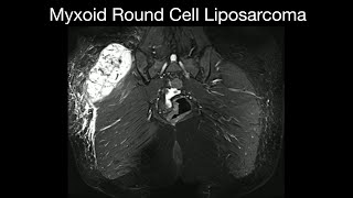 Myxoid Round Cell Liposarcoma [upl. by Nally]